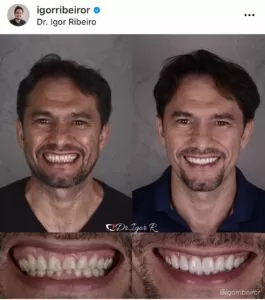 Home 9 Antes e depois de lentes dentais IPS e.max — correção de Bruxismo pelo Dr. Igor Ribeiro, Fortaleza-CE