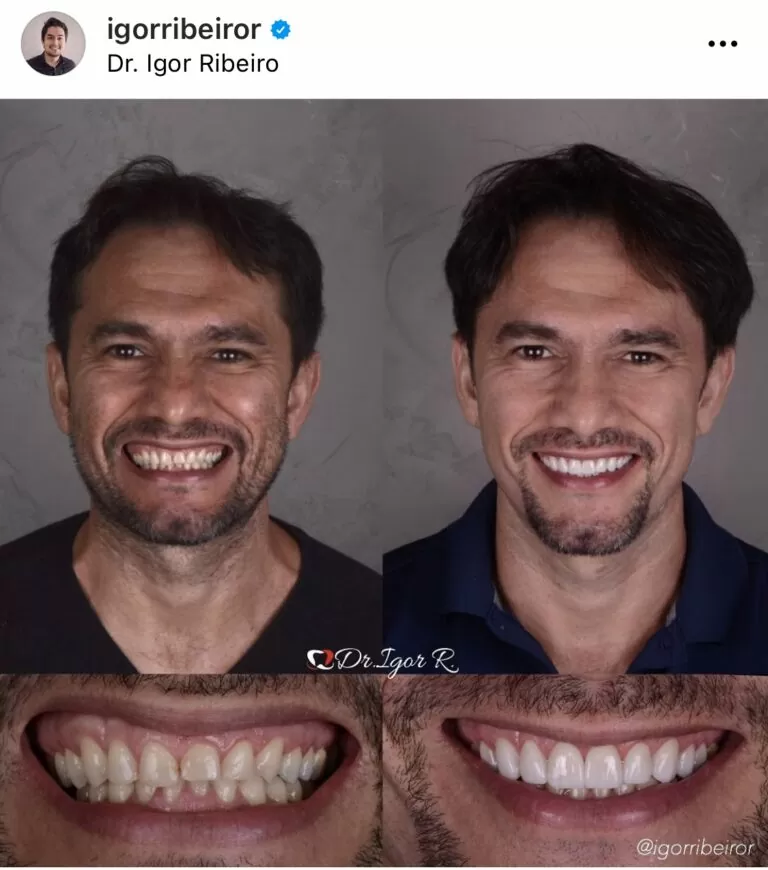 Antes e depois de lentes dentais IPS e.max — correção de Bruxismo pelo Dr. Igor Ribeiro, Fortaleza-CE
