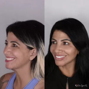 Home 7 Antes e depois de Harmionização facial — correção de Rugas e marcas de expressao com uso de preenchimento full face pelo Dr. Igor Ribeiro, Fortaleza-CE
