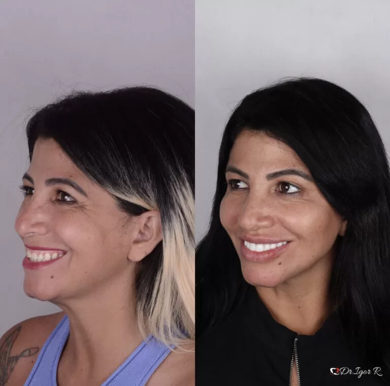 Home 24 Antes e depois de Harmionização facial — correção de Rugas e marcas de expressao com uso de preenchimento full face pelo Dr. Igor Ribeiro, Fortaleza-CE