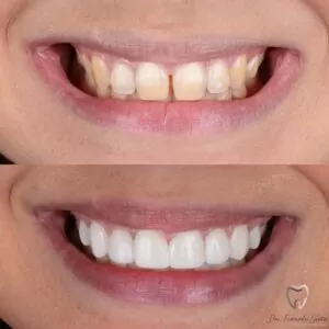 Leer más sobre el artículo Facetas de Resina em Fortaleza: Fotos [Antes/Depois] e Durabilidade