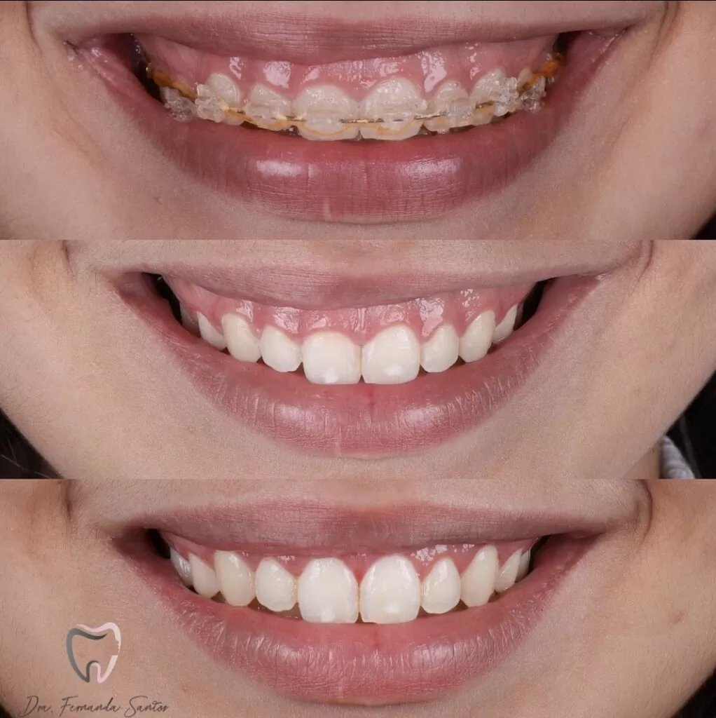 Gingivoplastia en Fortaleza
