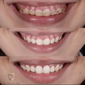 Read more about the article As 8 perguntas que todos fazem sobre Plástica Gengival Gengivoplastia