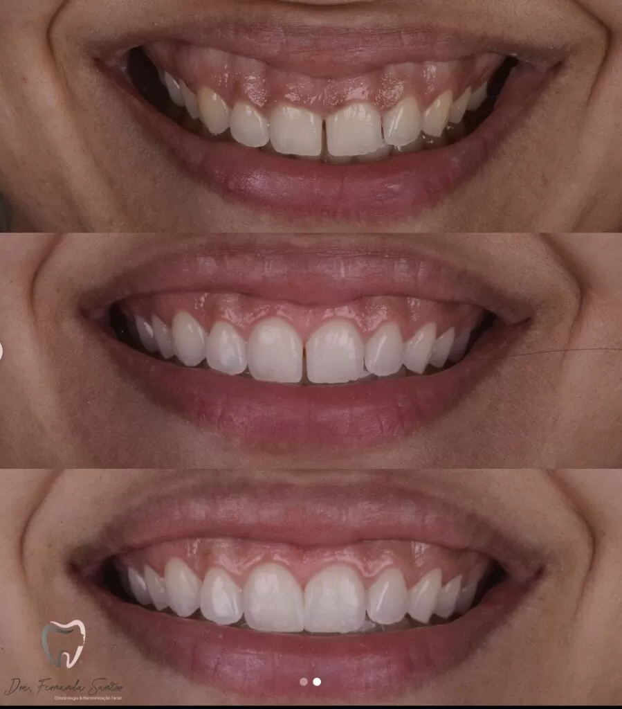 Gingivoplastia en Fortaleza