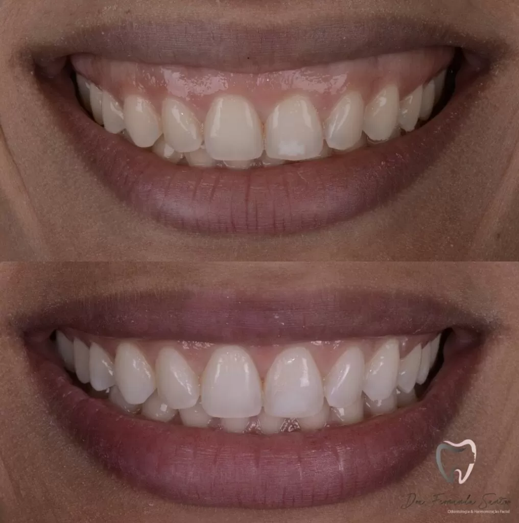 Gingivoplastia en Fortaleza