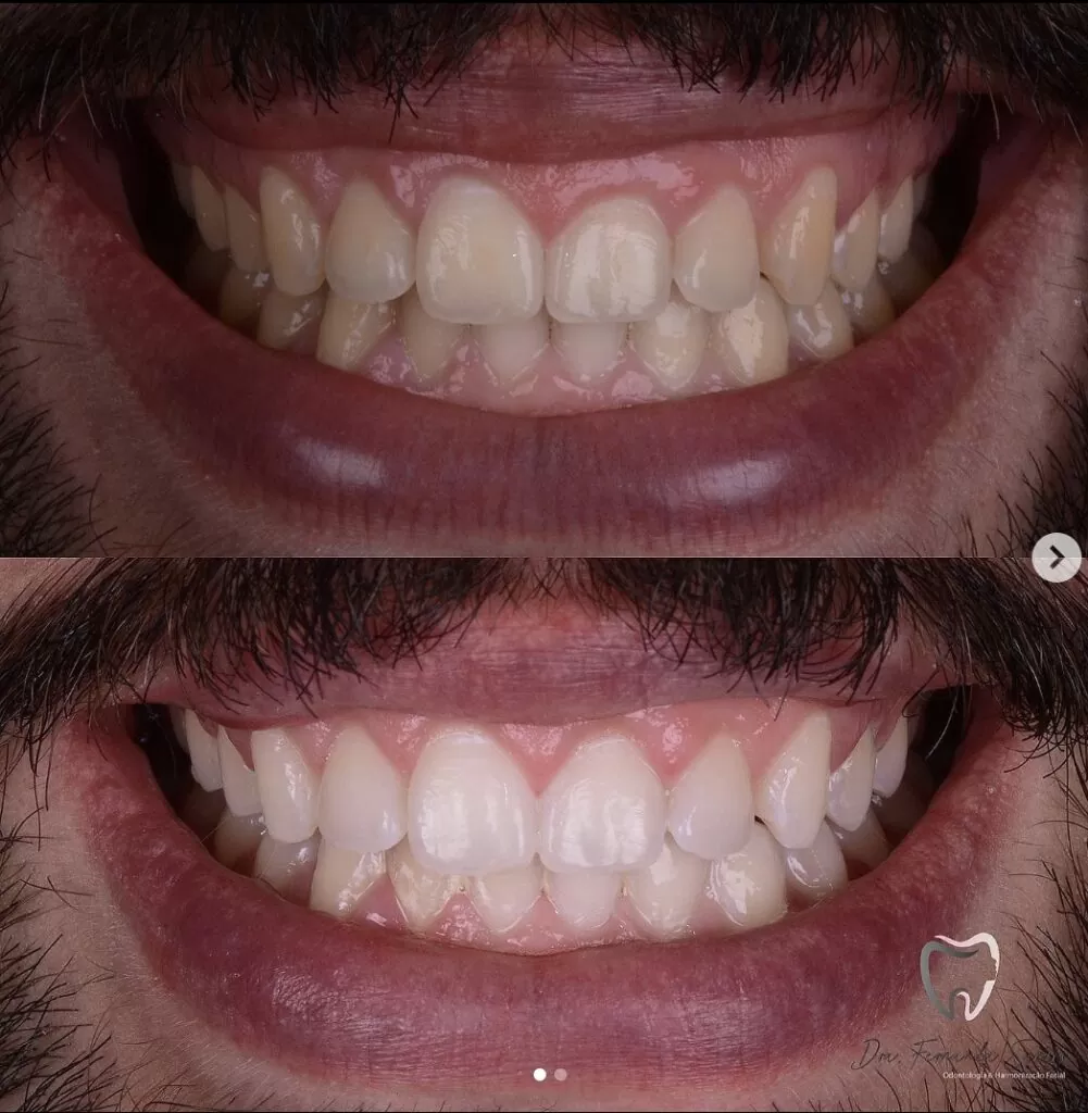 Gingivoplastia en Fortaleza