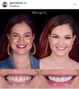 Youtuber Marina Benevides Dental contact lenses in porcelain veneer fortress