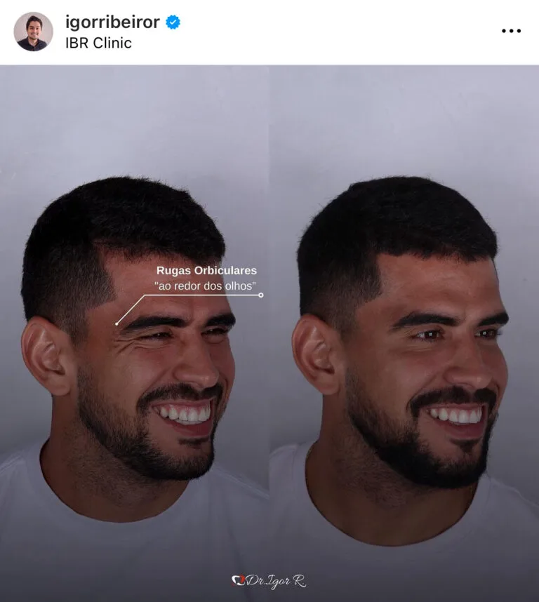 Botox em Fortaleza — IBR Clinic | Dr. Igor Ribeiro