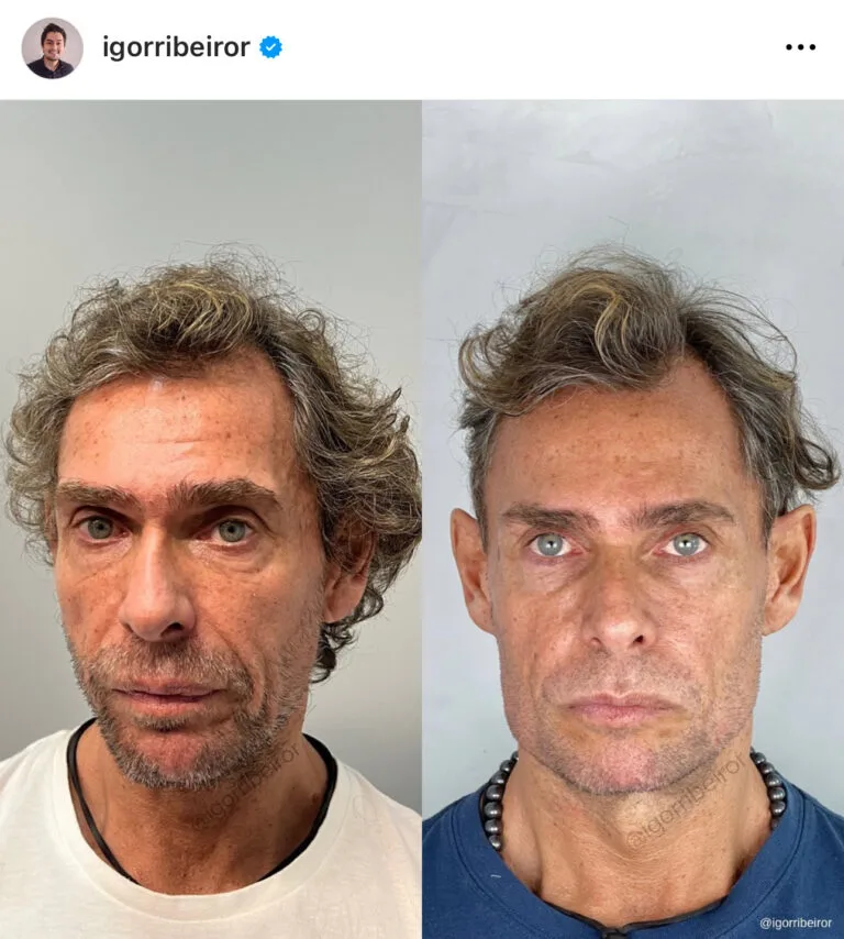 Preenchimento full face mandibula botox sculptra