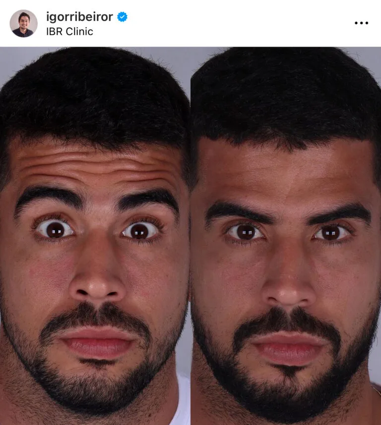 Botox na testa igor ribeiro dentista harmonizaçao facial