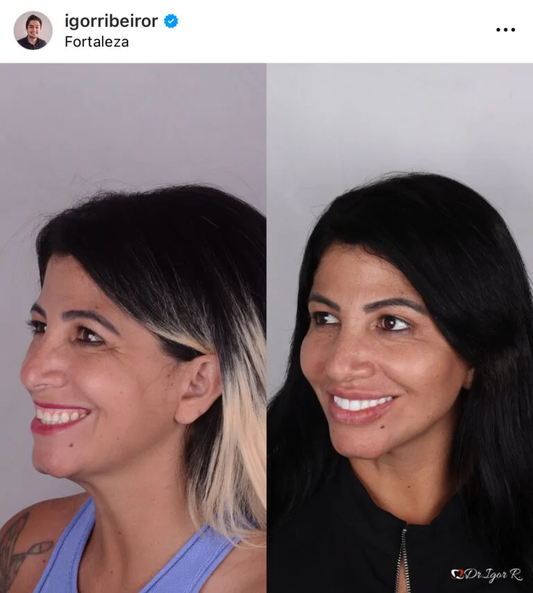 Preenchimento labial em fortaleza botox lentes de contato dental