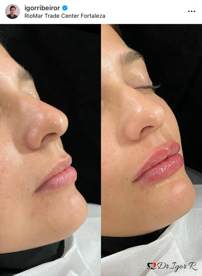 preenchimento labial em fortaleza