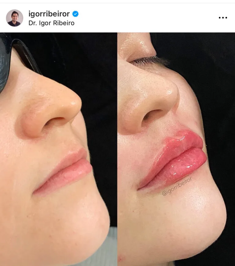 Preenchimento labial em Fortaleza — IBR Clinic | Dr. Igor Ribeiro