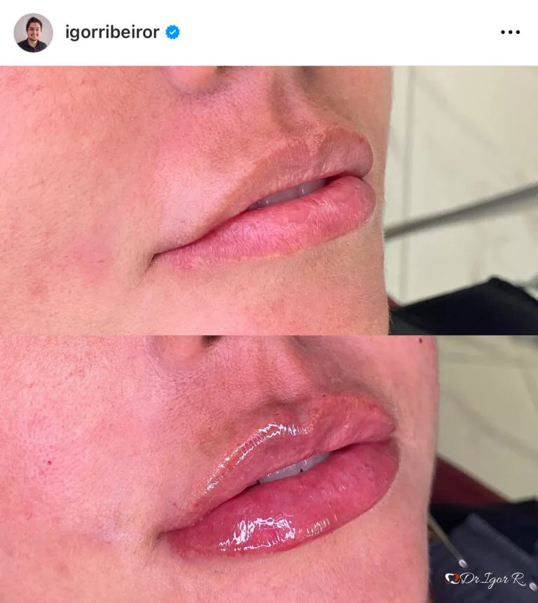 Preenchimento labial em Fortaleza — IBR Clinic | Dr. Igor Ribeiro
