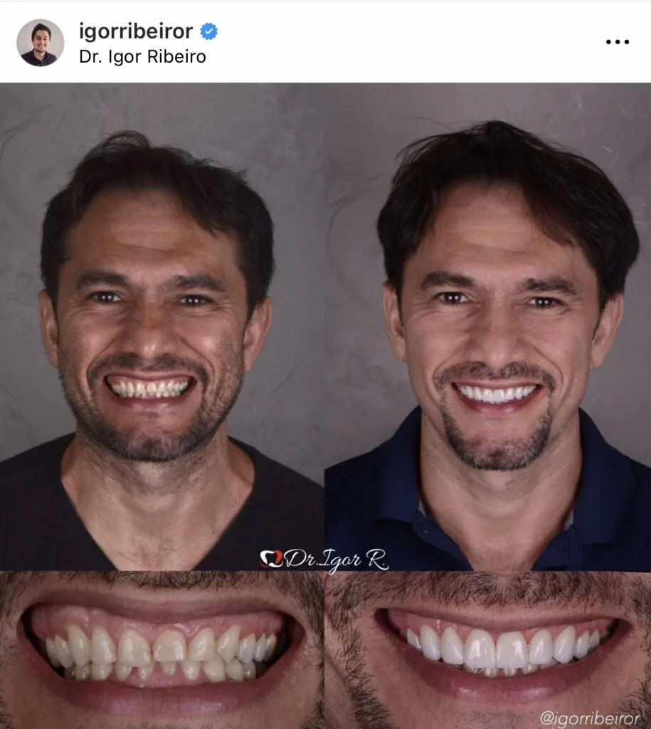 Dental bruxism patient improves smile with dental contact lens