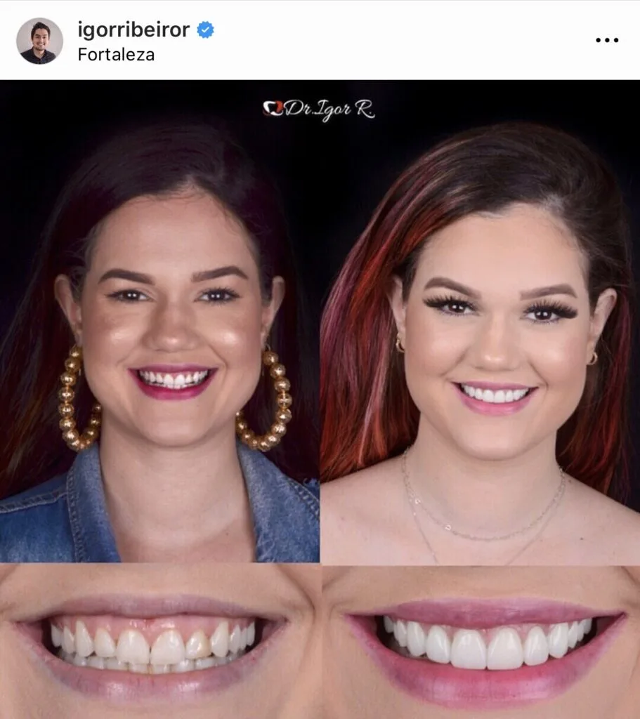 Youtuber Marina Benevides dental contact lens in Fortaleza