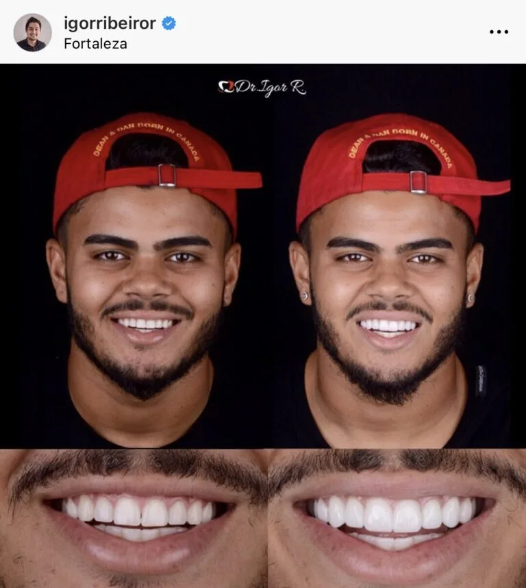 Jogador João Paulo São Paulo lente de contato dental em fortaleza Dr. Igor Ribeiro
