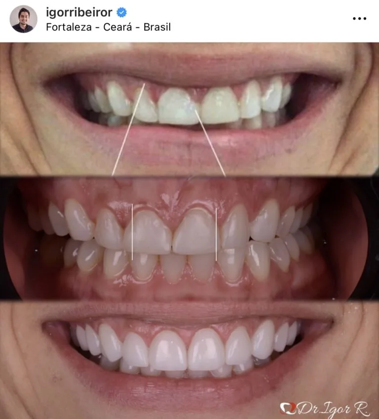 Gengivoplastia e Facetas em Porcelana Ceara Fortaleza