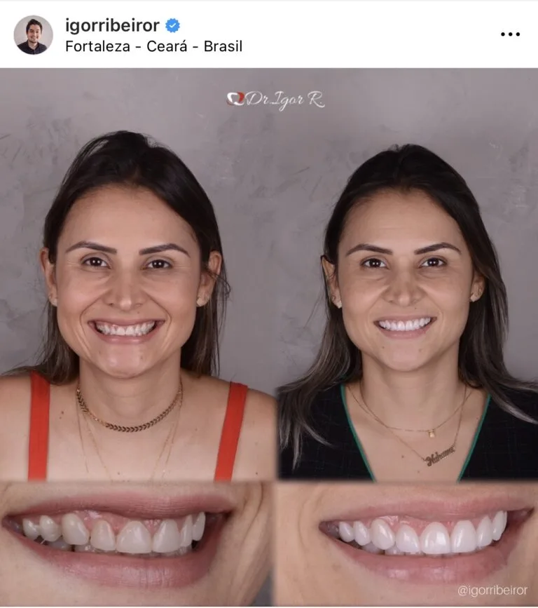 Transformação do sorriso com lentes de contato dental em fortaleza