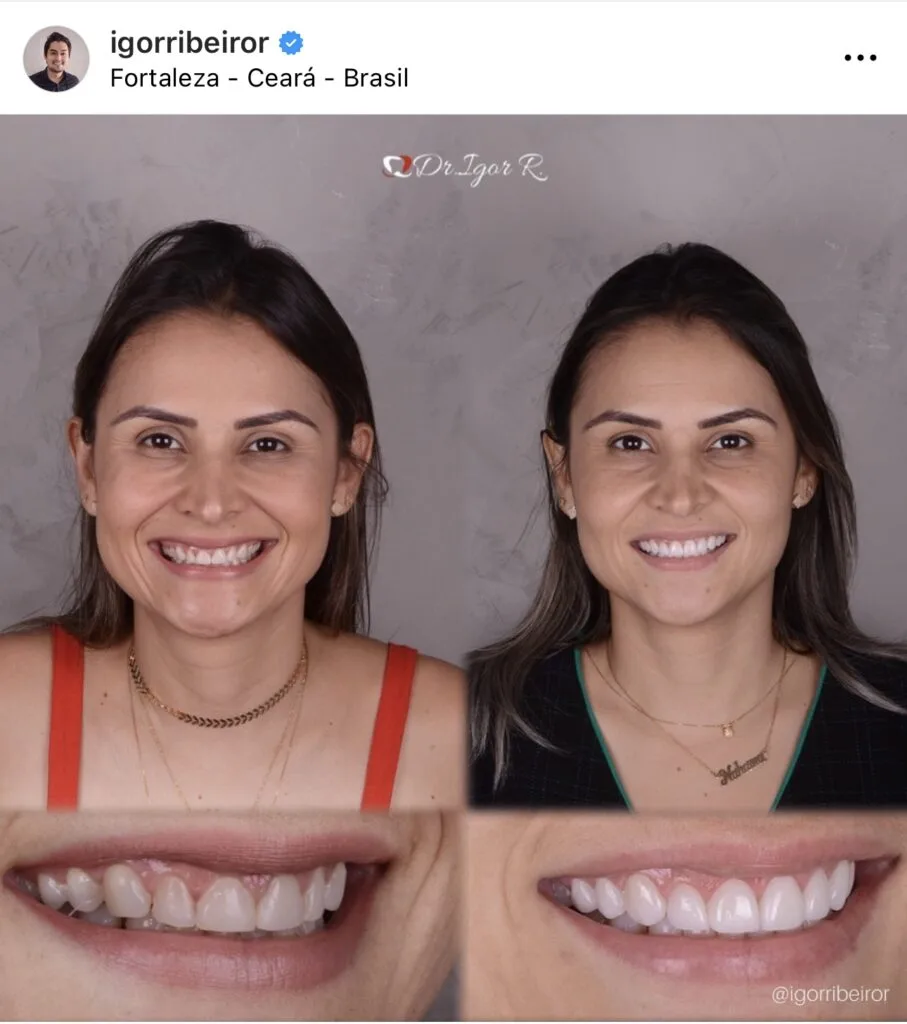 Smile transformation with dental contact lenses in Fortaleza
